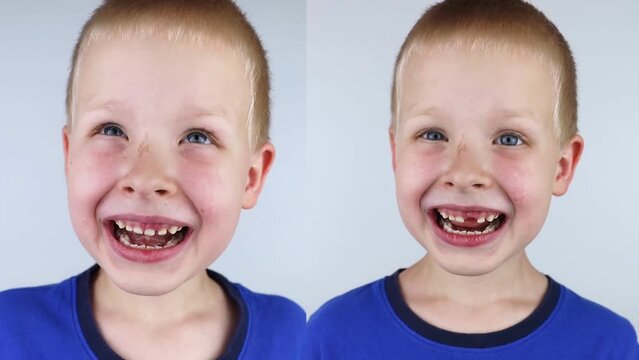 Before and after. Loose baby tooth. On left, boy milk tooth is loose, and on the right, it has already fallen out. Empty space in the place of the front teeth. Loss milk teeth