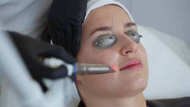 Woman getting YAG laser treatment for facial skin