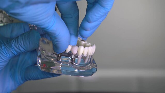 Human jaw model with implants in dentist's hands. Dental implant laboratory.