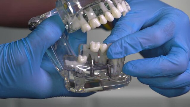 Human jaw model with implants in dentist's hands. Dental implant laboratory.