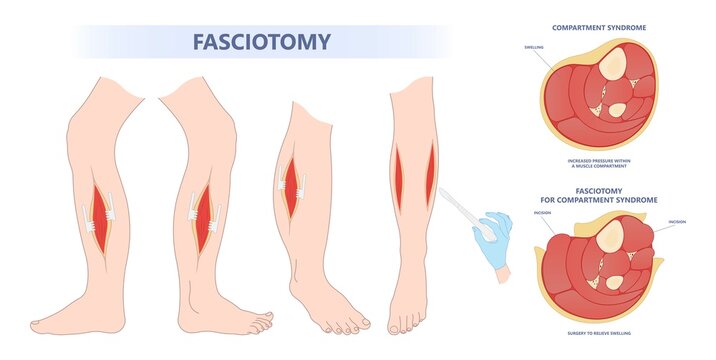 surgery for swollen foot with limb fascia edema disorder the fasciotomy acute pain crush ischemia deep vein broken bone skin graft and nerve