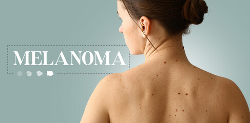 Young woman with moles and word MELANOMA on grey background - obrazy, fototapety, plakaty