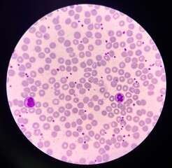 Platelet smear increase more than 25 cells in oil filed.