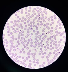 Platelet smear increase more than 25 cells in oil filed.