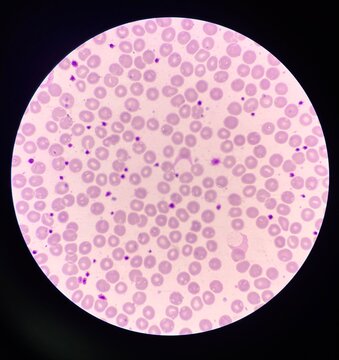 Platelet smear increase more than 25 cells in oil filed.