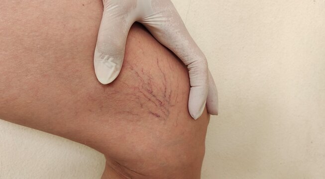 Portrait showing the hand holding the flabbiness skin and varicose veins on the leg, circulation of blood, problem wrinkle and Inflammation skin of the patient woman, concept health care.