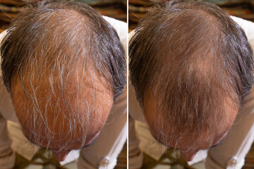 before and after baldness treatment. Details of a man's hair