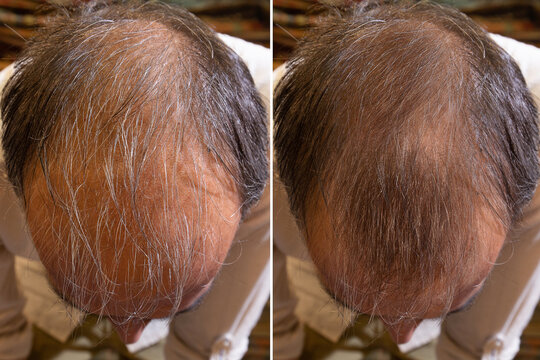 before and after baldness treatment. Details of a man's hair
