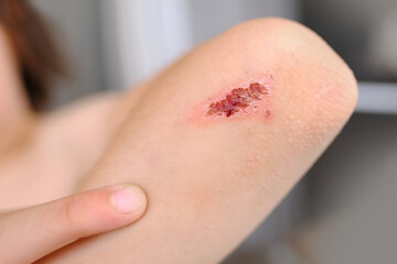 healing wound on child's hand, crusted abrasion in elbow area, scar, traumatic safety concept for...