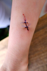 fresh wound on child's leg, non-absorbable sutures, wound care after skin procedure with sutures, trauma safety concept for children, treatment of surgical wounds, medical care, antiseptic treatment