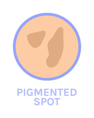 Pigmented Spots on the Skin. Skin Problem. Pigmentation. Closeup Brown Spots. Icon. Color Cartoon style. White background. Vector illustration for Beauty and Medical Design.