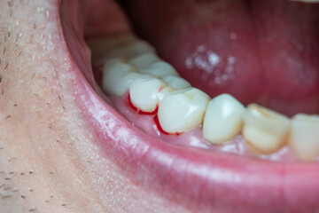Caucasian male open mouth showing bleeding gums and a row of white teeth and back of the throat....