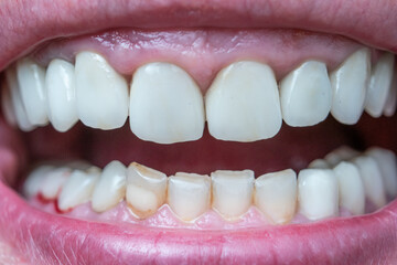 Caucasian male open mouth showing row of white teeth and back of the throat. Close up macro shot, unrecognizable face