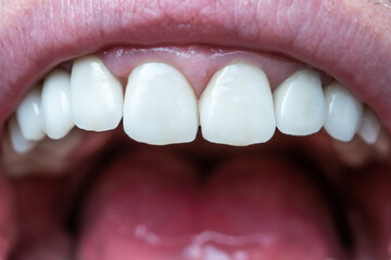 Caucasian male open mouth showing row of white teeth and back of the throat. Close up macro shot,...
