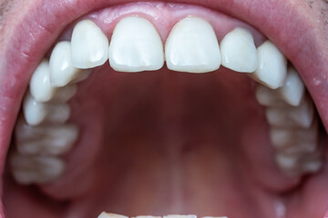 Caucasian male open mouth showing row of white teeth and back of the throat. Close up macro shot,...