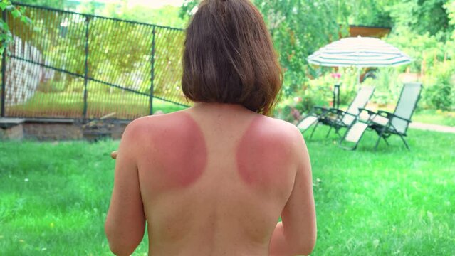 Close up of a woman's back with uneven pigmentation. woman applying sunscreen to back at the lawn near the house. High quality 4k footage