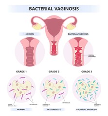 HIV or AIDS with Vagina bacterial sex odor fishy Foul smelling good Preterm birth of herpes simplex virus and Pelvic trich cervix yeast pap smear cancer pain rash lactic acid tract syndrome atrophy