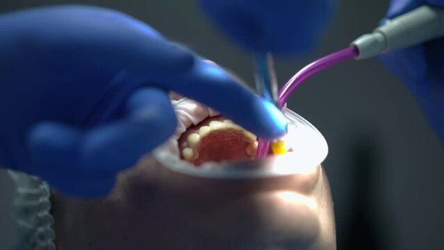 Close-up patient mouth with retractor and dentist injecting anesthesia as assistant removing saliva with sucking tube. Caucasian male patient in dental chair undergoing treatment in slow motion