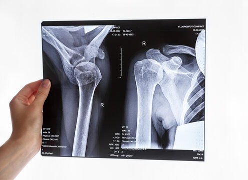 Hand holding shoulder, clavicle X-ray image. Acromion, acromial end fracture. Arm trauma. Health care, injury diagnostics concept. High quality photo