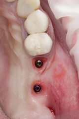 Fototapeta premium two dental implants in the gum before installing two crowns