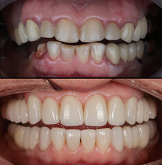 two dental photos before and after prosthetics with crowns of the upper and lower jaws
