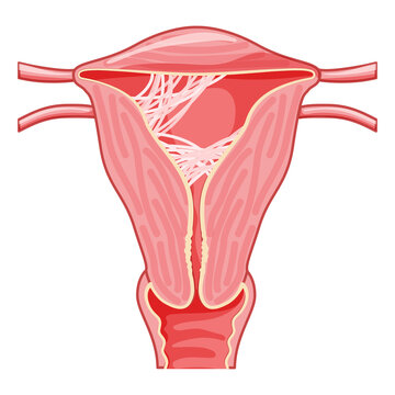 Asherman Syndrome Female Reproductive System Scar Tissue Adhesions In Uterus. Front View In A Cut. Human Anatomy Internal Organs Location Scheme, Cervix, Ovary, Fallopian Tube Flat Style Icon