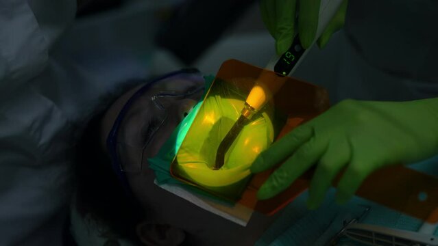 Close-up curing light shield on mouth of patient with dental curing light. Unrecognizable Caucasian dental assistant doing polymerization of filling material in slow motion in hospital
