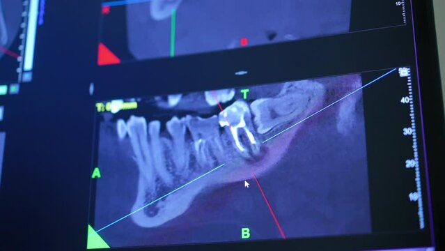 Close-up screen with 3D dental imaging in modern hospital indoors. Panoramic X-ray of jaw and teeth with cone beam scanner. Modern technologies and dentistry concept