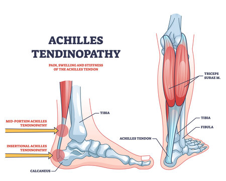 Achilles tendinopathy as injury to tendon in heel outline diagram. Labeled educational scheme with anatomical leg and foot skeleton and muscles vector illustration.Trauma and band of tissue problem.