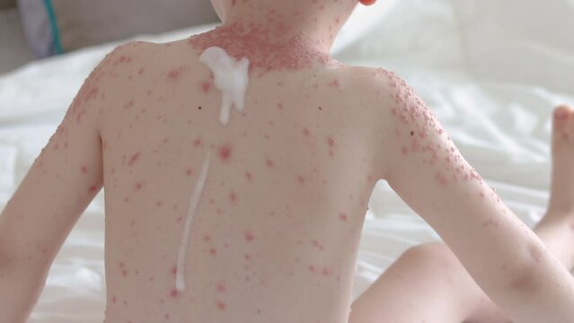 little baby boy with severe form of varicella,chickenpox virus.pouring white foam on child's neck,shoulder and hands.kid crying,feeling pain.blisters on child body.nettle rash spread over all body