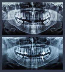 orthopantomograph panoramic image radiograph of teeth © Claudio Divizia