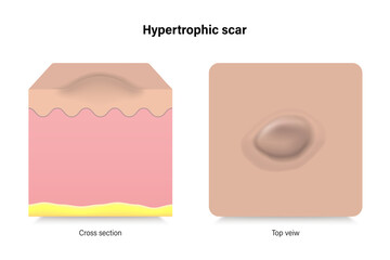 Hypertrophic scars. Facial skin problems. Vector for advertising about beauty and medical treatment.