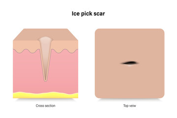 Ice pick scar. Facial skin problems. Vector for advertising about beauty and medical treatment.