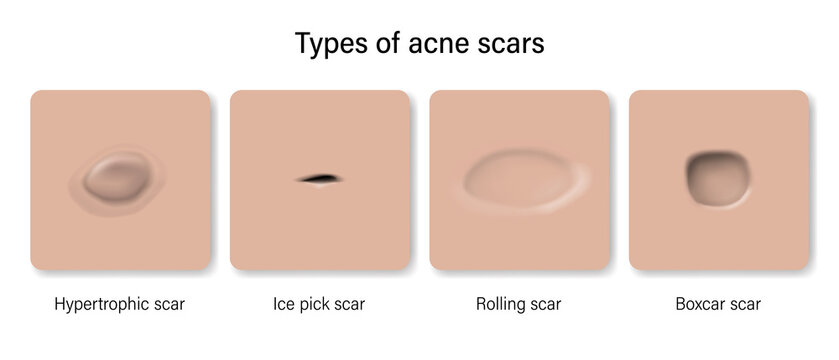 Types Of Acne Scars. Facial Skin Problems. Hypertrophic Scar, Ice Pick, Rolling And Boxcar. Vector For Advertising About Beauty And Medical Treatment.