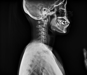 Normal cervical spine of a girl , X - ray Cervical spine after had an accident .