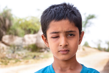 child boy with one eye disability