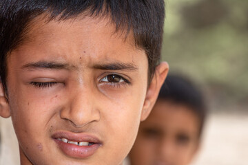 child boy with one eye disability