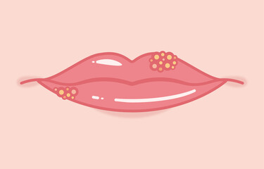 Illustration of herpes labialis seen from the front