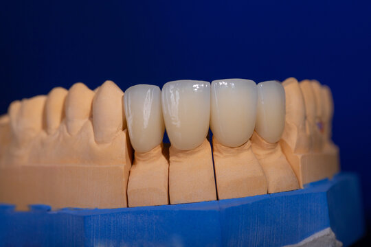 Frames of ceramic crowns on a gypsum model. Zirconia crowns. Metal-free ceramics at the manufacturing stage. Close-up, black isolate