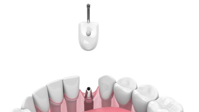 dental implant  installation into lower jaw over white background 