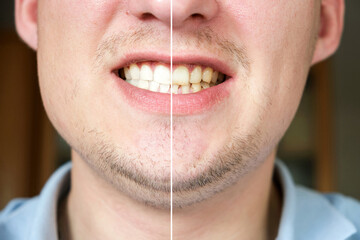 Caucasian man before and after teeth whitening procedure, closeup.  Concept oral care dentistry, whitening procedure, stomatology. Close-up