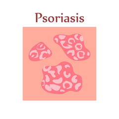 Psoriasis on human skin. Dermatological disease. The symptom is itching, pain, peeling, redness and rash. Allergic reaction. Medical diagnostics and treatment. Vector illustration