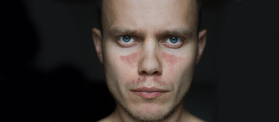 man with allergic dermatitis, red spots on his face. Autoimmune disease lupus.