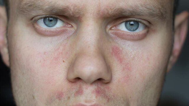 young man with redness and allergic dermatitis on his face.