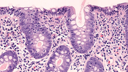 Photomicrograph of lymphocytic colitis, a type of microscopic colitis, showing increased numbers of...