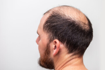 male head with thinning hair or alopecia - obrazy, fototapety, plakaty