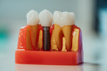 Dental prosthetics concept. Showing the installation of a dental implant on the anatomical model of teeth, close-up