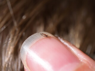 Finding and removing lice from the hair of a child's head - obrazy, fototapety, plakaty