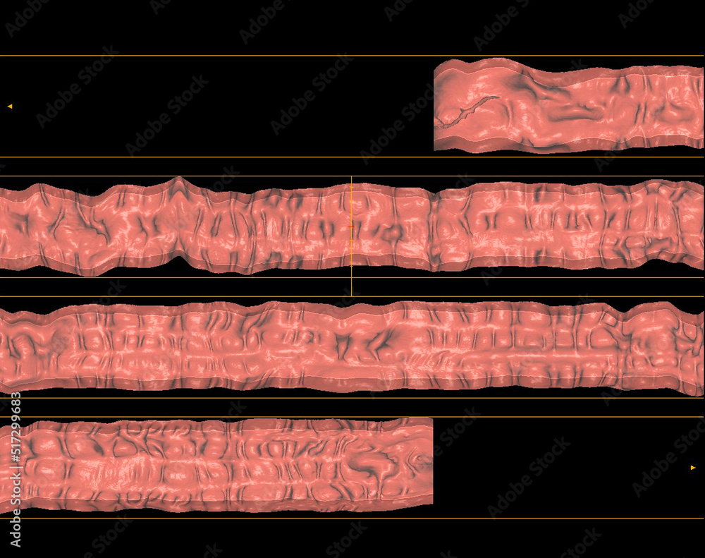 Poster ct colonography or ct scan of colon rendering image .