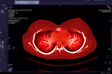 CT Chest or CT Scan of Lung Axial and Coronal  View.